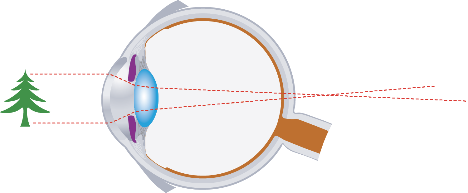 oeil hypermetropepotentiel vision 1