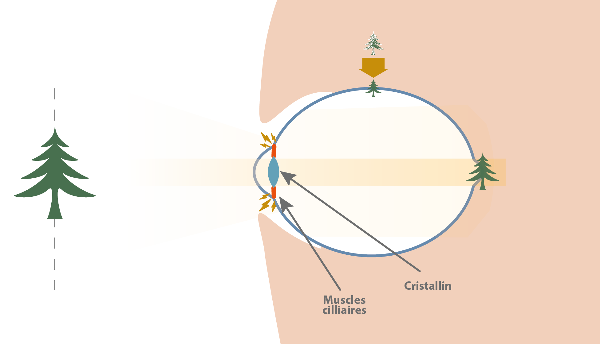 Les verres freinateurs de myopie : une bonne idée ? 7 oeil myopie evolutive