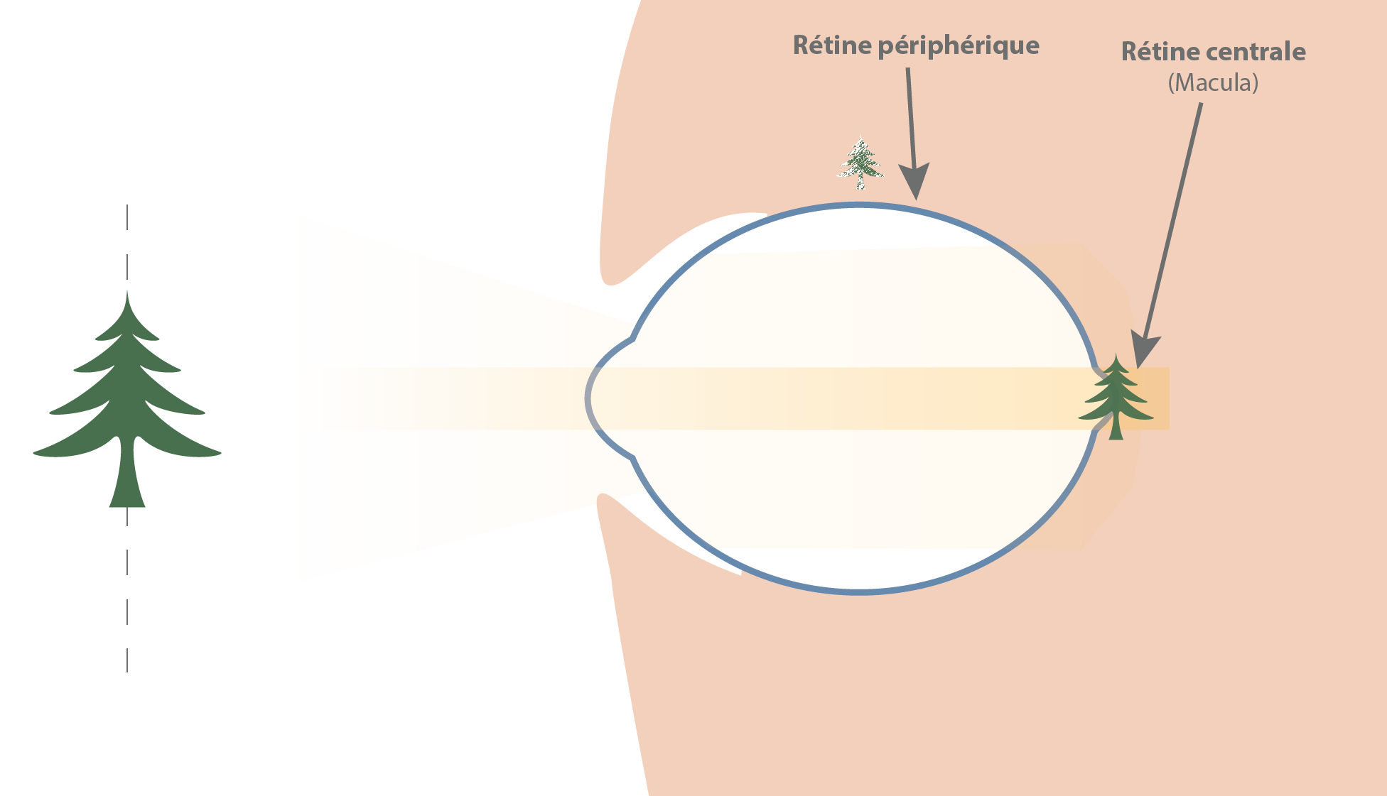 Les verres freinateurs de myopie : une bonne idée ? 6 potentiel vision oeil myopise