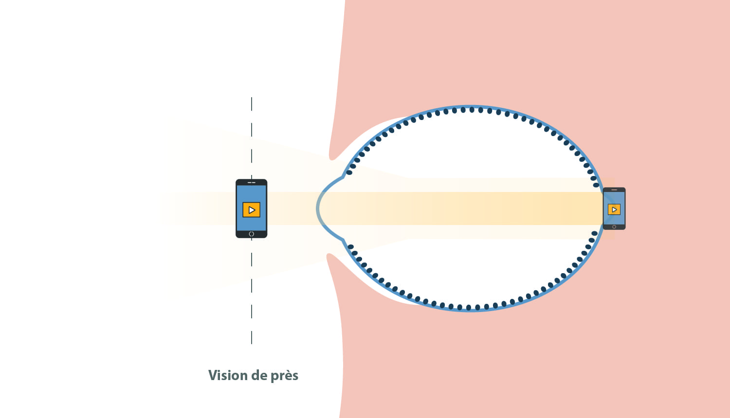 Les verres freinateurs de myopie : une bonne idée ? 3 vision de pres myope